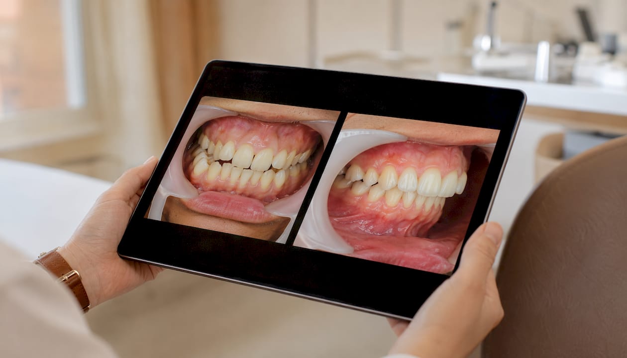 Tipuri de malocluzie dentară: principalele diferențe și caracteristici