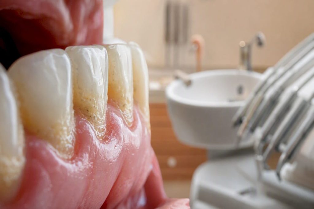 Prim-plan cu placă dentară pe dinți, aproape de gingii
